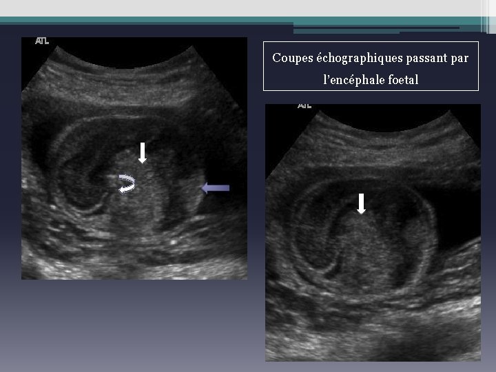 Coupes échographiques passant par l’encéphale foetal 