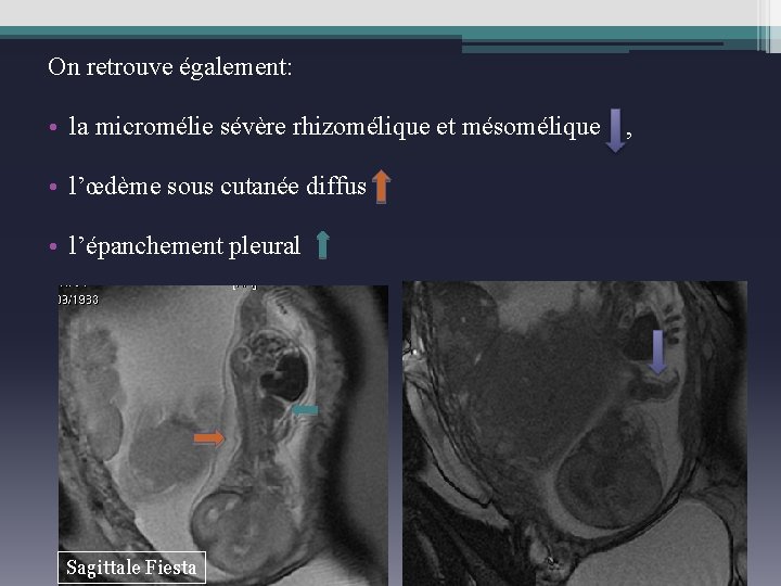 On retrouve également: • la micromélie sévère rhizomélique et mésomélique , • l’œdème sous