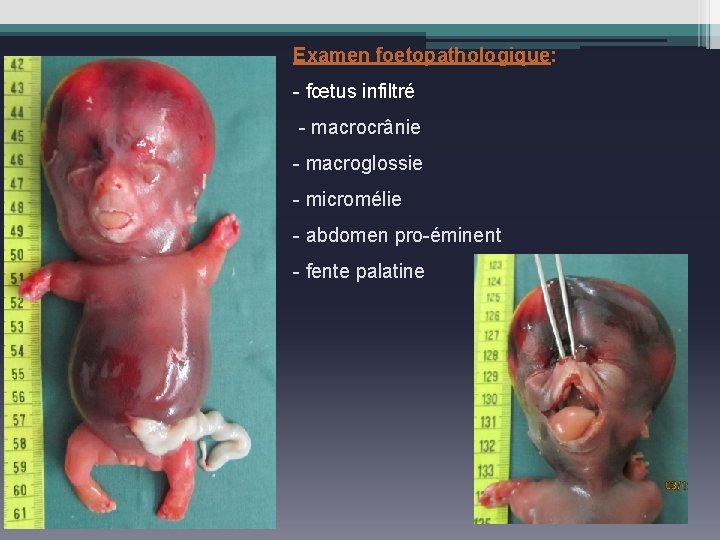 Examen foetopathologique: - fœtus infiltré - macrocrânie - macroglossie - micromélie - abdomen pro-éminent