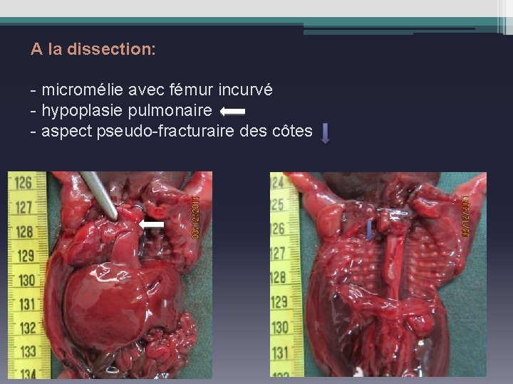 A la dissection: - micromélie avec fémur incurvé - hypoplasie pulmonaire - aspect pseudo-fracturaire