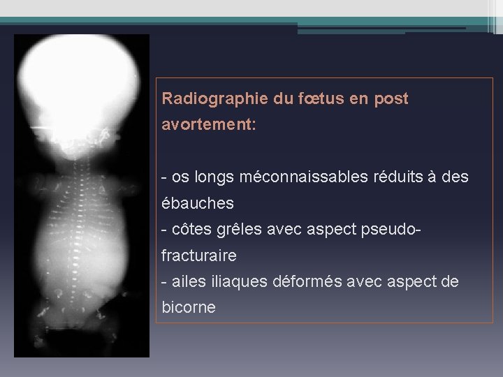 Radiographie du fœtus en post avortement: - os longs méconnaissables réduits à des ébauches