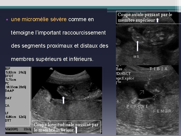  • une micromélie sévère comme en témoigne l’important raccourcissement des segments proximaux et