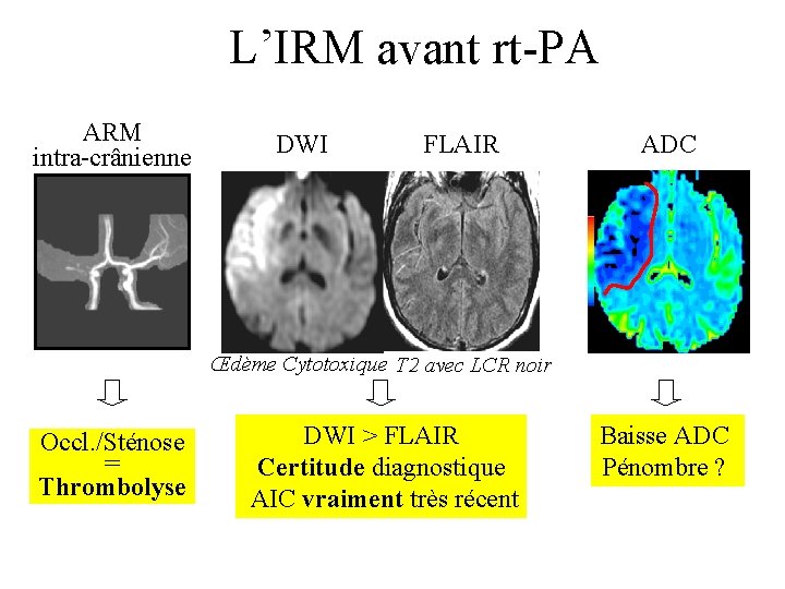 L’IRM avant rt-PA ARM intra-crânienne DWI FLAIR ADC Œdème Cytotoxique T 2 avec LCR