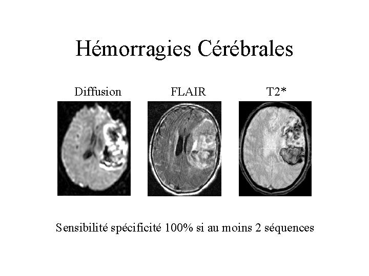 Hémorragies Cérébrales Diffusion FLAIR T 2* Sensibilité spécificité 100% si au moins 2 séquences