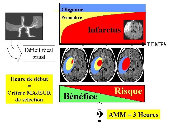 Oligémie Pénombre Infarctus TEMPS Déficit focal brutal Heure de début = Critère MAJEUR de