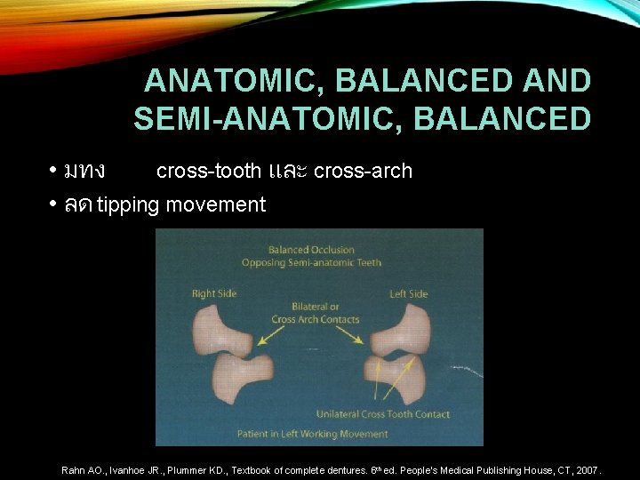 ANATOMIC, BALANCED AND SEMI-ANATOMIC, BALANCED • มทง cross-tooth และ cross-arch • ลด tipping movement