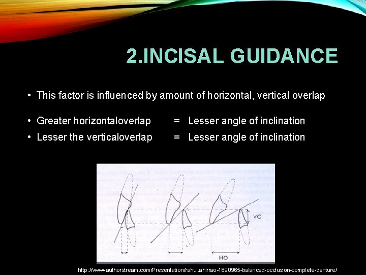 2. INCISAL GUIDANCE • This factor is influenced by amount of horizontal, vertical overlap