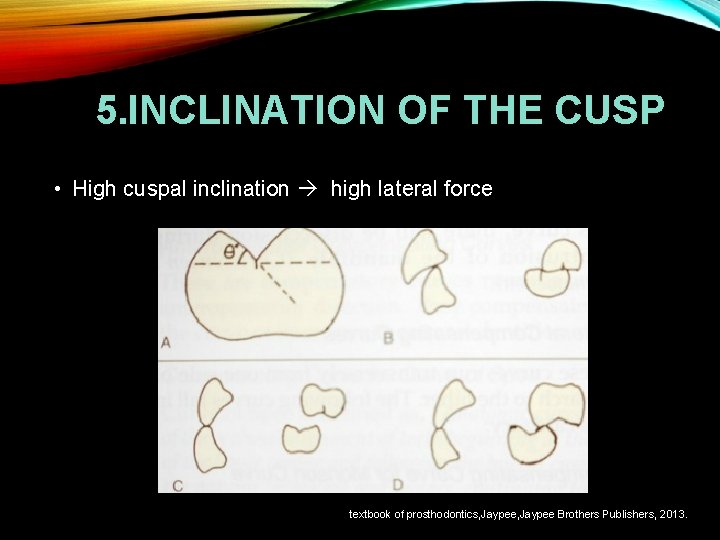 5. INCLINATION OF THE CUSP • High cuspal inclination high lateral force textbook of