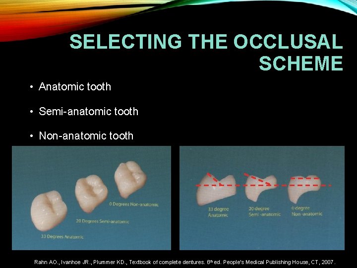 SELECTING THE OCCLUSAL SCHEME • Anatomic tooth • Semi-anatomic tooth • Non-anatomic tooth Rahn