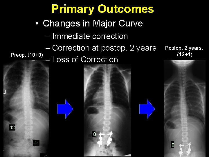 Primary Outcomes • Changes in Major Curve Preop. (10+0) – Immediate correction – Correction