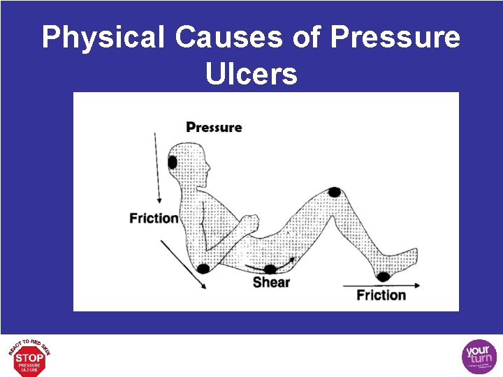 Physical Causes of Pressure Ulcers 