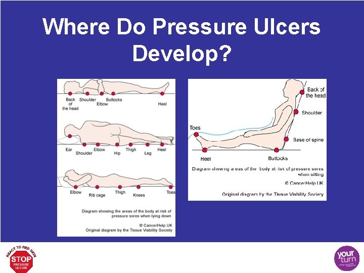 Where Do Pressure Ulcers Develop? 