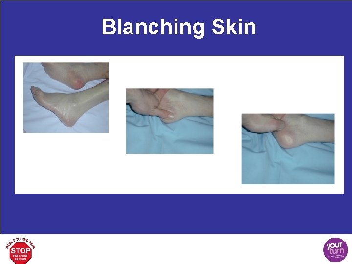 Blanching Skin 