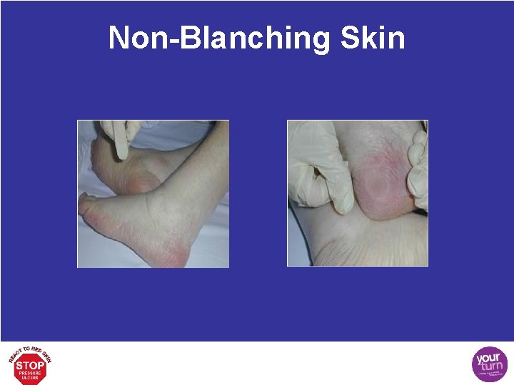 Non-Blanching Skin 