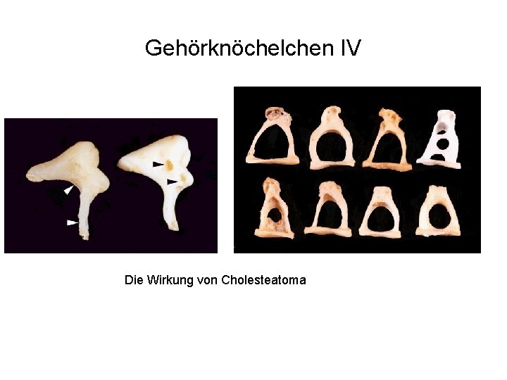 Gehörknöchelchen IV Die Wirkung von Cholesteatoma 
