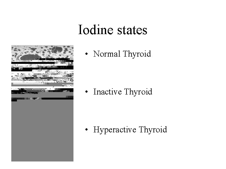 Iodine states • Normal Thyroid • Inactive Thyroid • Hyperactive Thyroid 