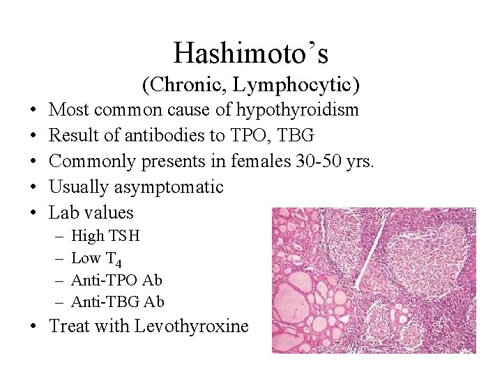 Hashimoto’s (Chronic, Lymphocytic) • • • Most common cause of hypothyroidism Result of antibodies