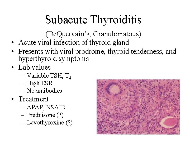 Subacute Thyroiditis (De. Quervain’s, Granulomatous) • Acute viral infection of thyroid gland • Presents