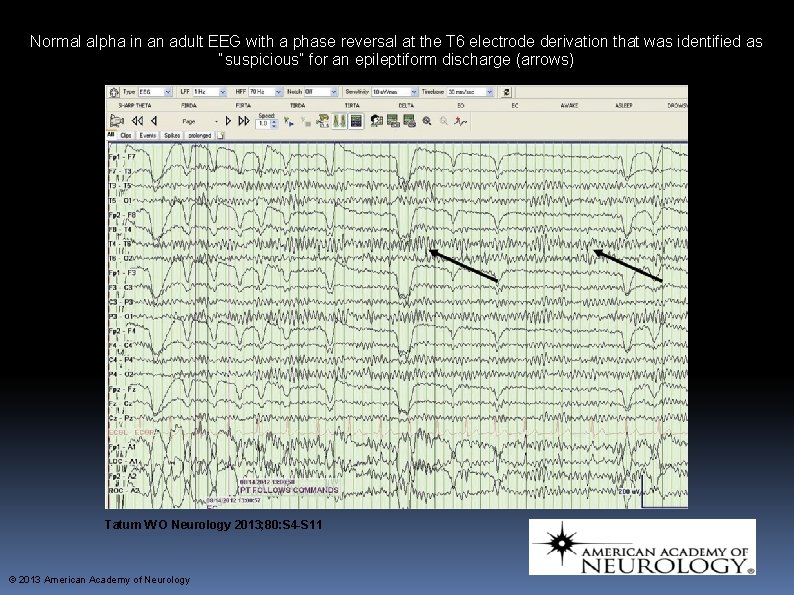 Normal alpha in an adult EEG with a phase reversal at the T 6