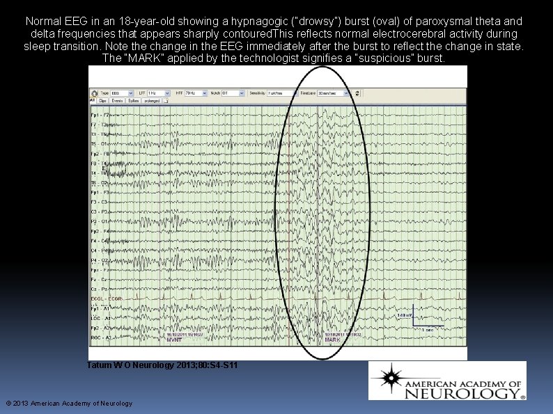Normal EEG in an 18 -year-old showing a hypnagogic (“drowsy”) burst (oval) of paroxysmal