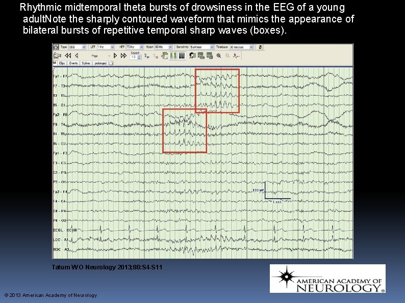 Rhythmic midtemporal theta bursts of drowsiness in the EEG of a young adult. Note