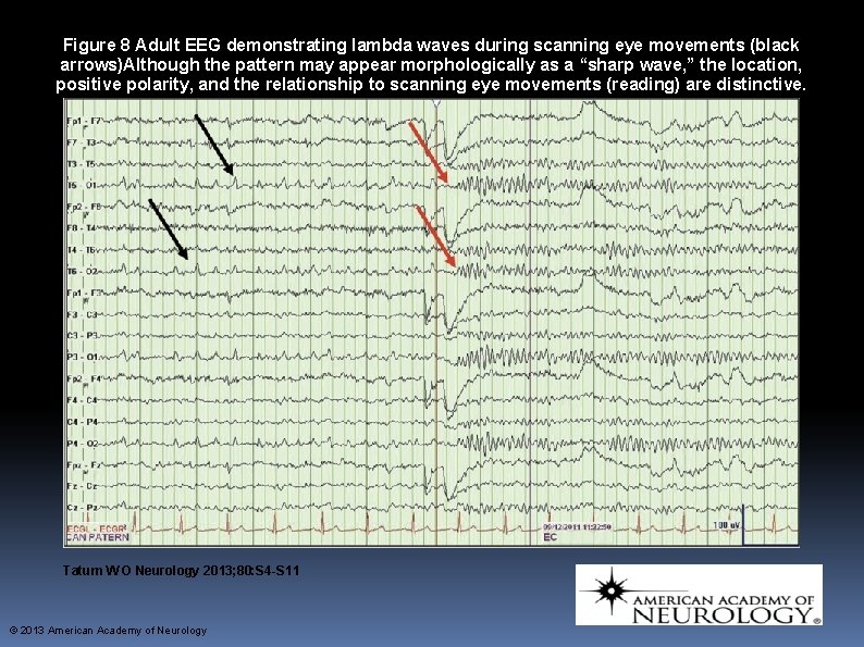 Figure 8 Adult EEG demonstrating lambda waves during scanning eye movements (black arrows)Although the