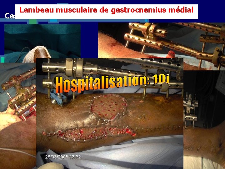 Lambeau musculaire de gastrocnemius médial Cas n° 2 