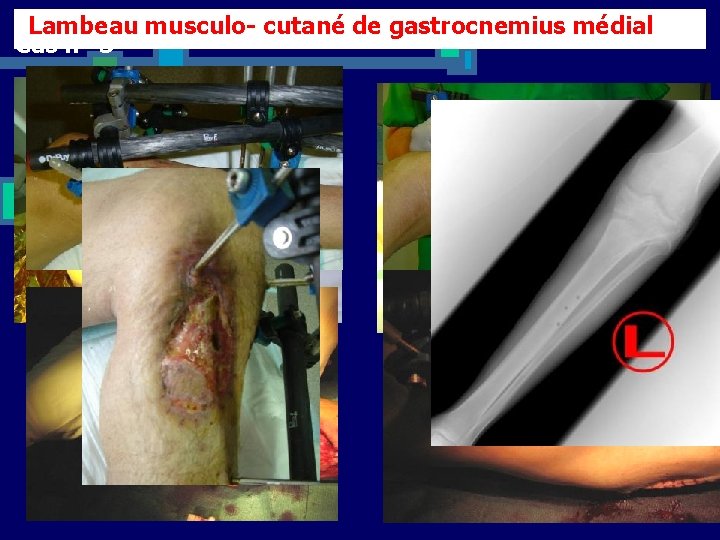 Lambeau musculo- cutané de gastrocnemius médial Cas n° 3 