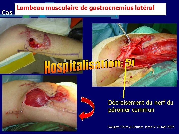 Lambeau musculaire de gastrocnemius latéral Cas n° 4 Décroisement du nerf du péronier commun