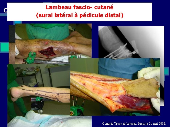 Cas n° 5 Lambeau fascio- cutané (sural latéral à pédicule distal) Congrès Trucs et