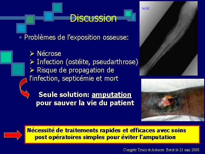 Discussion • Problèmes de l’exposition osseuse: Ø Nécrose Ø Infection (ostéite, pseudarthrose) Ø Risque