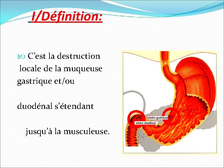 I/Définition: C’est la destruction locale de la muqueuse gastrique et/ou duodénal s’étendant jusqu’à la