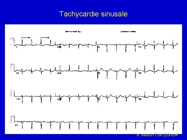 Tachycardie sinusale R. Renault TDR (2006)® 