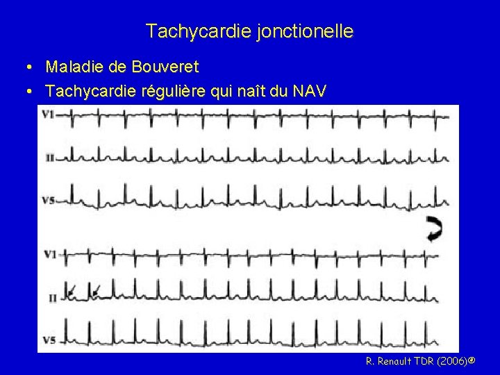 Tachycardie jonctionelle • Maladie de Bouveret • Tachycardie régulière qui naît du NAV R.