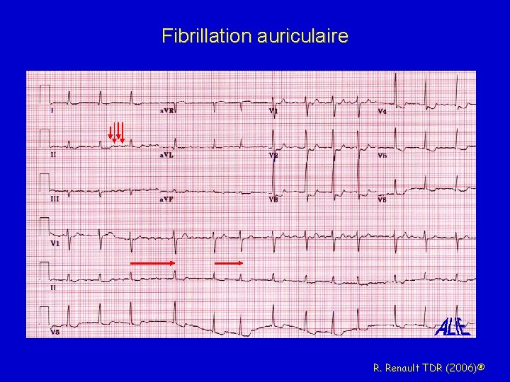 Fibrillation auriculaire R. Renault TDR (2006)® 