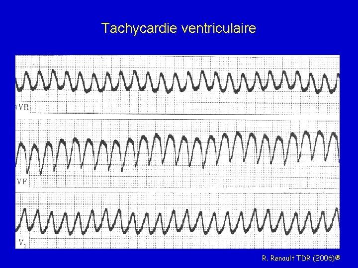 Tachycardie ventriculaire R. Renault TDR (2006)® 