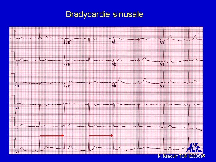 Bradycardie sinusale R. Renault TDR (2006)® 