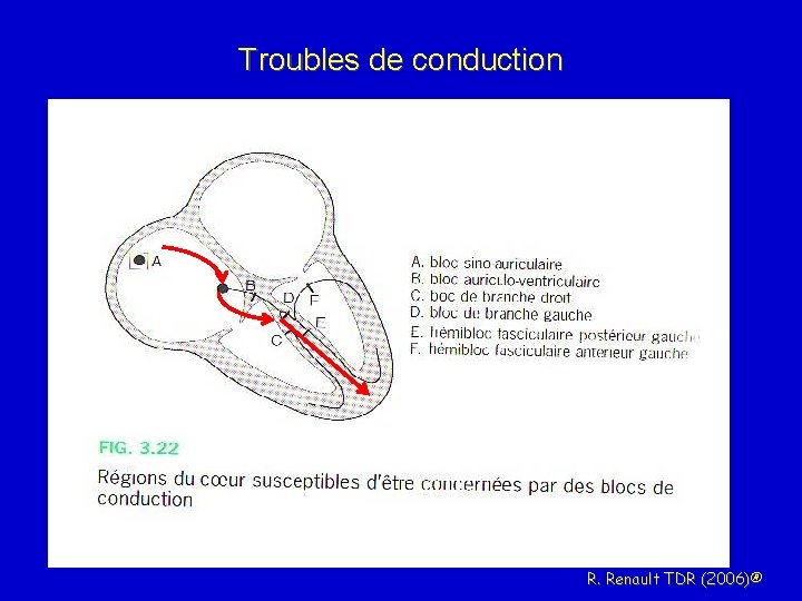 Troubles de conduction R. Renault TDR (2006)® 