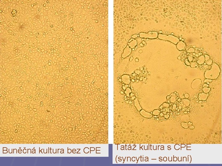 Buněčná kultura bez CPE Tatáž kultura s CPE (syncytia – soubuní) 