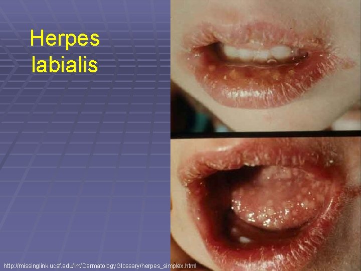 Herpes labialis http: //missinglink. ucsf. edu/lm/Dermatology. Glossary/herpes_simplex. html 