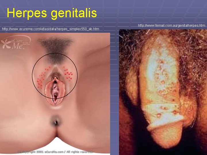 Herpes genitalis http: //www. ecureme. com/atlas/data/herpes_simplex 550_ab. htm http: //www. femail. com. au/genitalherpes. htm