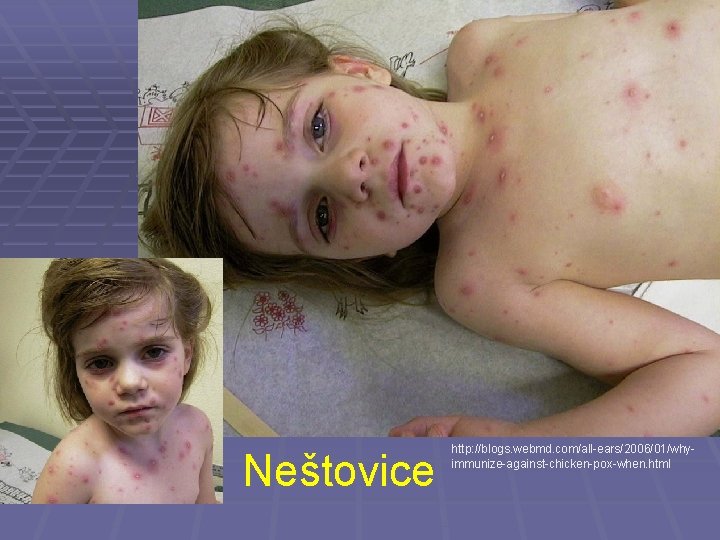 Neštovice http: //blogs. webmd. com/all-ears/2006/01/whyimmunize-against-chicken-pox-when. html 