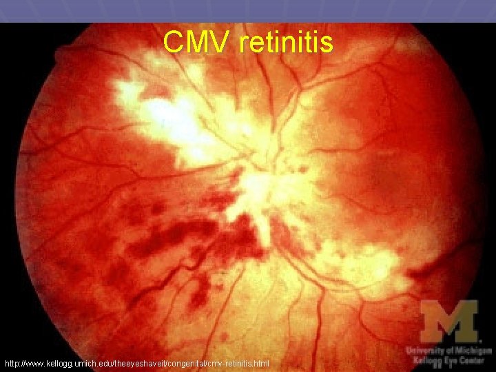 CMV retinitis http: //www. kellogg. umich. edu/theeyeshaveit/congenital/cmv-retinitis. html 