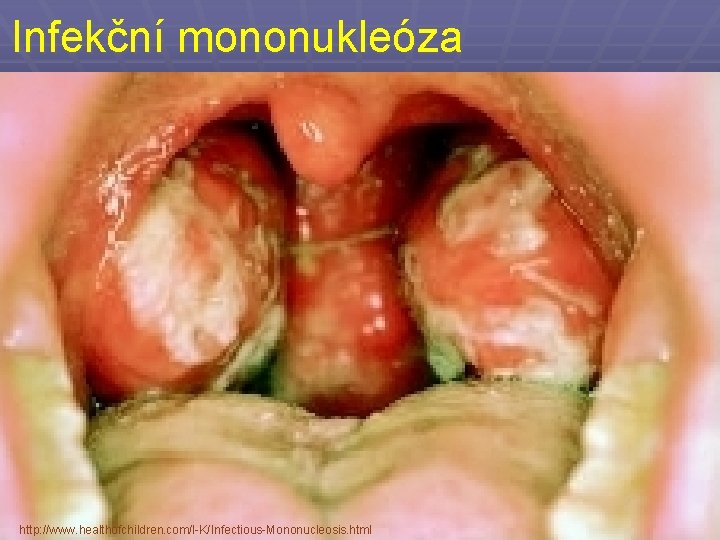 Infekční mononukleóza http: //www. healthofchildren. com/I-K/Infectious-Mononucleosis. html 