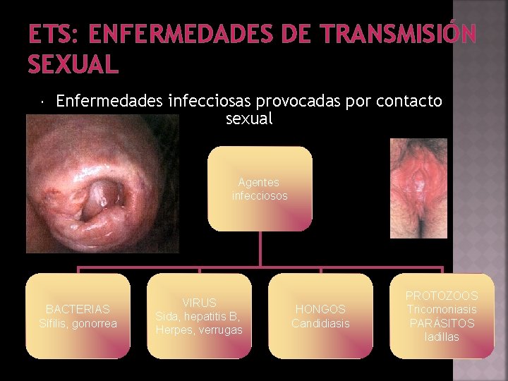 ETS: ENFERMEDADES DE TRANSMISIÓN SEXUAL Enfermedades infecciosas provocadas por contacto sexual Agentes infecciosos BACTERIAS