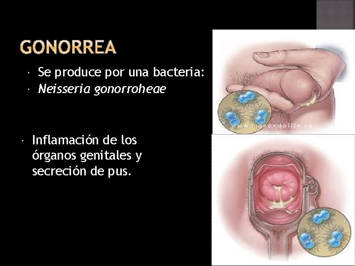  Se produce por una bacteria: Neisseria gonorroheae Inflamación de los órganos genitales y