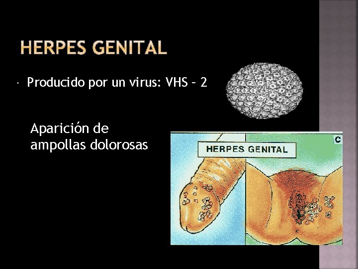  Producido por un virus: VHS – 2 Aparición de ampollas dolorosas 