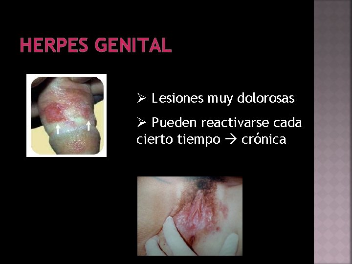 HERPES GENITAL Ø Lesiones muy dolorosas Ø Pueden reactivarse cada cierto tiempo crónica 