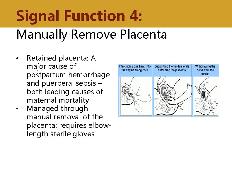 Signal Function 4: Manually Remove Placenta • • Retained placenta: A major cause of