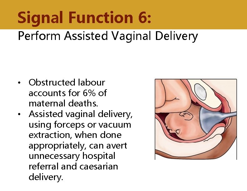 Signal Function 6: Perform Assisted Vaginal Delivery • Obstructed labour accounts for 6% of